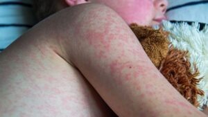 Measles, an alarming increase in France in 2024: nearly 500 cases identified
