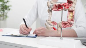 Colon cancer, these foods reduce or increase your chances of survival, according to a new study