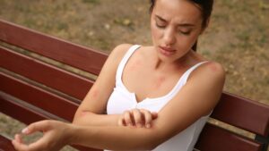 How to recognize a tiger mosquito bite? Dr Gérald Kierzek's responses