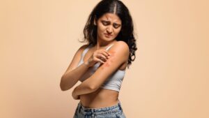 "My body burns me, but it is in the head that it hurts the most": how to live with an eczema without sinking