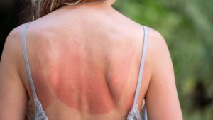 "Burn lines": the Tiktok trend that literally burns the skin of teens, the expert alert!