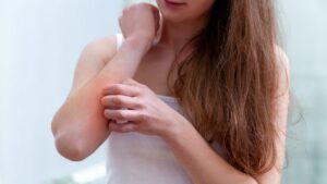 Mosquito bite: beware of Skeeter syndrome, a reaction that can become serious ... Here are the signs to watch