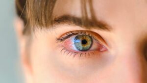 PhotoKeratitis: Yes, your eyes can also catch a sunburn this summer