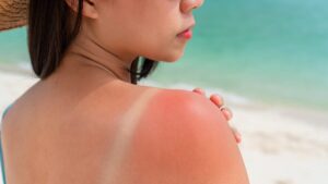 Sunburn: "Here is the product to always have on hand to appease them," says Dr. Gérald Kierzek