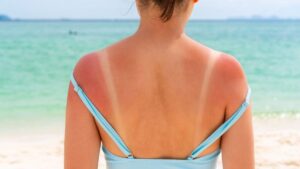 Sunburn, how many days should you wait before re-exposing yourself according to a doctor?