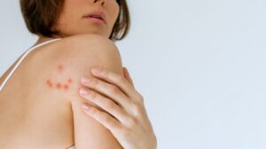 Three signs not to ignore after a mosquito bite