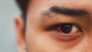 He has been suffering from the eyes for months, the cause was alive and installed in his eye globe