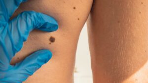 Acne, melanoma, eczema: dermatological tele-expertise shakes up care paths