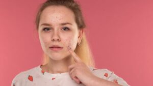 Acne, the back -to -school trap: why the buttons come back and how to prevent them
