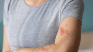 After swimming, this rash hid more than an allergy to chlorine ... The explanations of Dr Kierzek