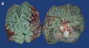 Autopsies: The amazing cause behind the brains with blue shades