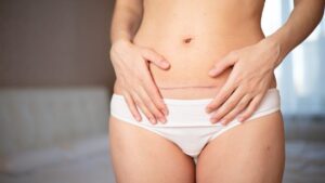Caesarean scar: signs that prove that it evolves well (and those who must alert)