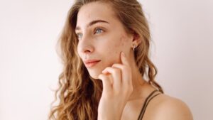 Do you suffer from acne? This new treatment validated in Europe could change everything