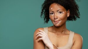 "Fighting every day so as not to tear the skin": when skin diseases affect identity, mental health and social relationships