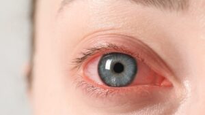 "It burned me as not possible": an American confuses her eye drops with her nail glue