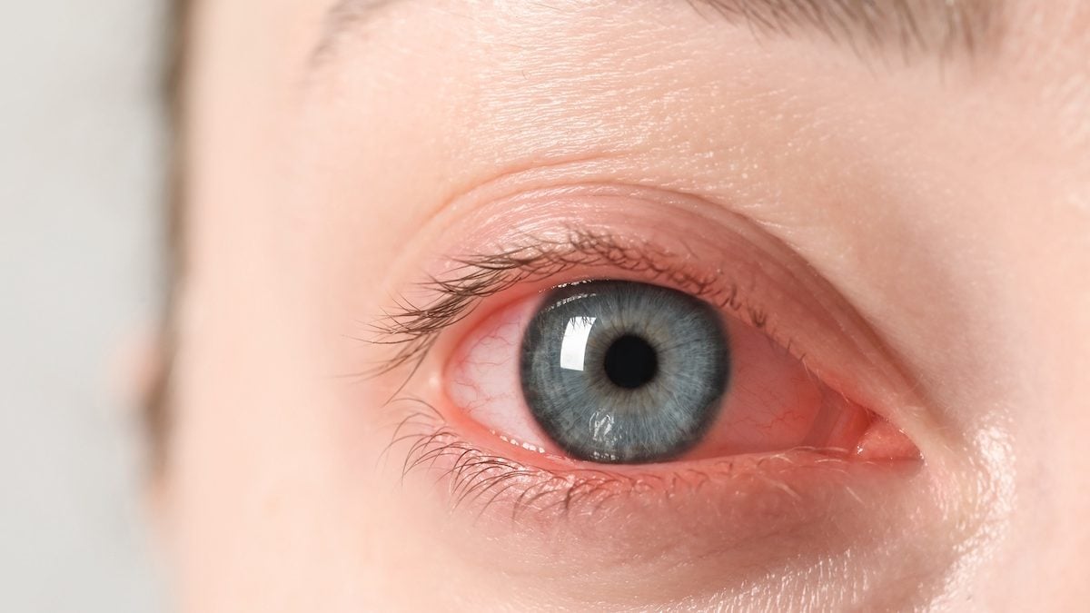 "It burned me as not possible": an American confuses her eye drops with her nail glue