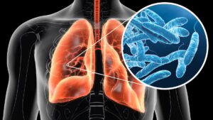 Legionellosis, 5 deaths in New York: the symptoms to know to avoid confusion with COVID