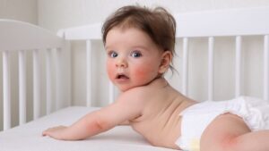 What if your baby's eczema found its origin before birth?