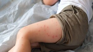 Measles, 828 cases and 2 dead in France since January: why vaccination remains vital