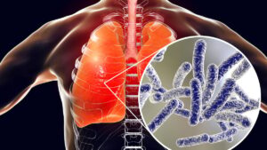 After the cases of Albertville, how do you know if your symptoms fall under covid or legionellosis?