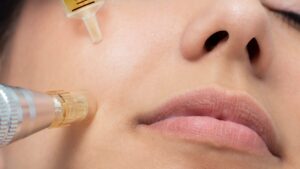 Home needle pens: Beauty innovation or risk for skin? A dermatologist gives his opinion