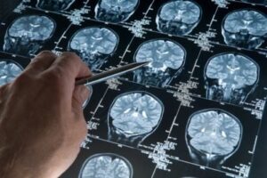 Microplastics reach the brain and could accelerate Alzheimer's