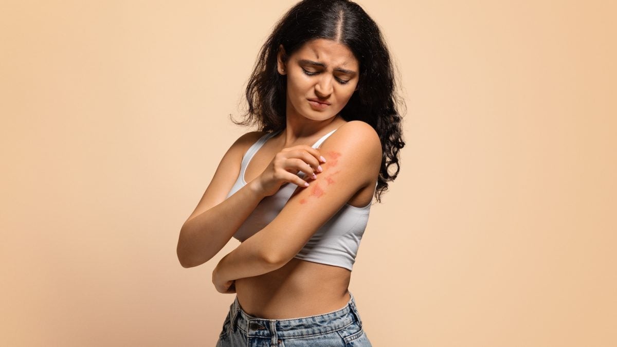 Psoriasis: watch out for dietary advice delivered on Instagram, alert researchers