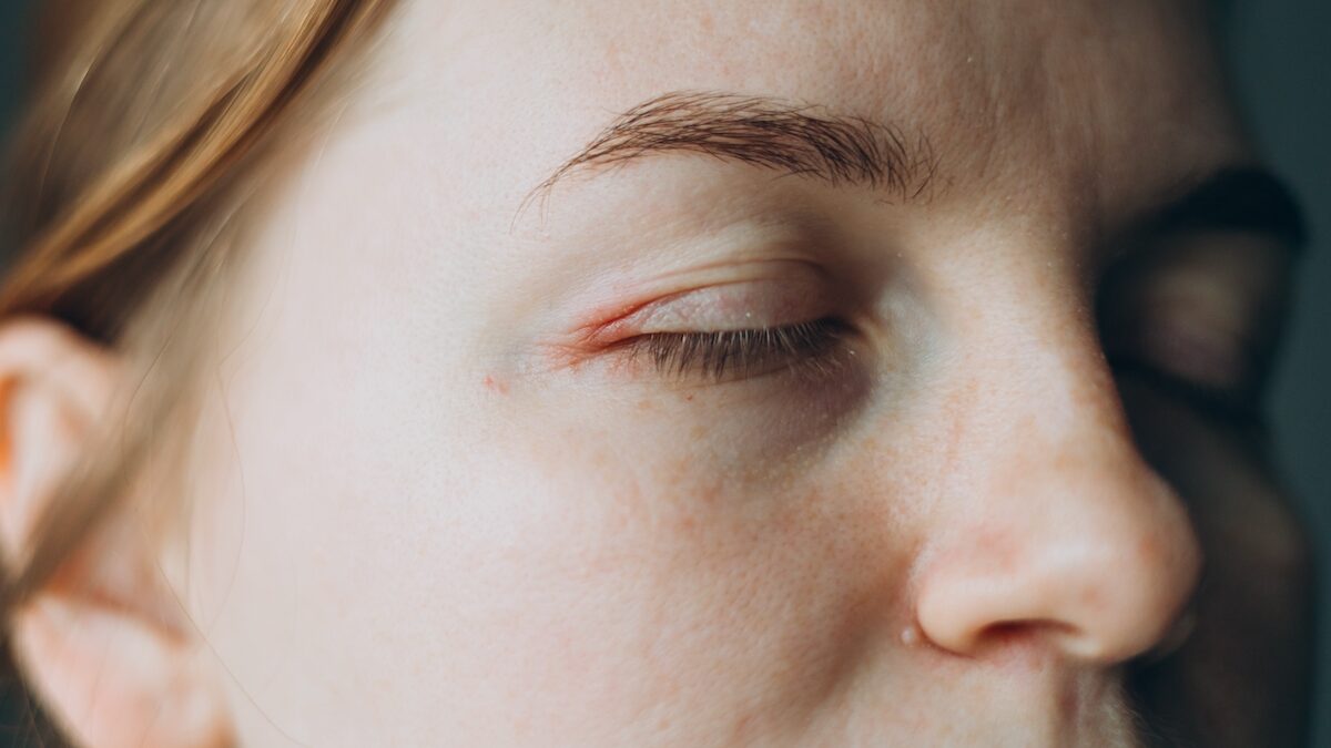 She felt something moving under her eyelid: the doctors removed an 11 cm worm. Shocking images!