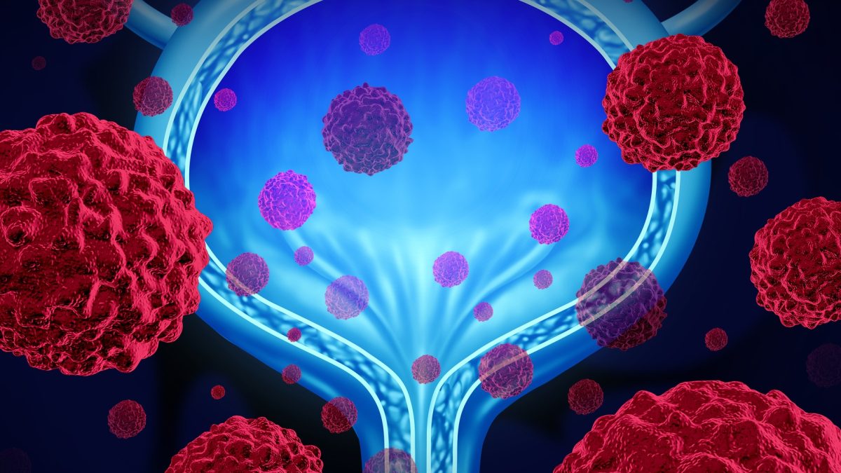 Bladder cancer: a virus that almost all French people caught during childhood could be the cause of these tumors