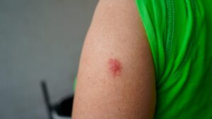 Red or purplish marks on the skin: when should you worry? Dr. Kierzek's answers