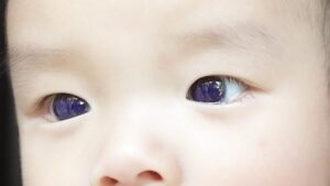 This anti-Covid treatment given to a baby changes the color of his eyes