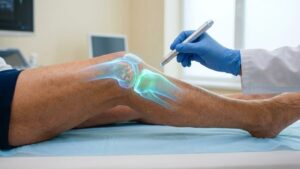 Osteoarthritis of the knee: this anti-aging injection regenerates the cartilage!