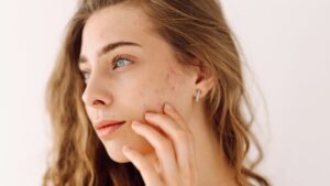 Succinic acid: the new ally for acne-prone skin (and the scalp)