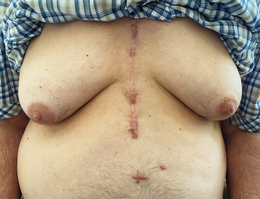 A 76-year-old man consulted for a gradual increase in breast volume over the past 8 months.