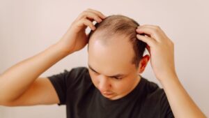Baldness: after 30 years of waiting, can Breezula really change the situation?