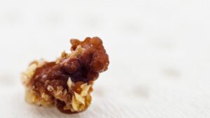 Burglars think they are stealing precious stones, and leave with their victim's kidney stones