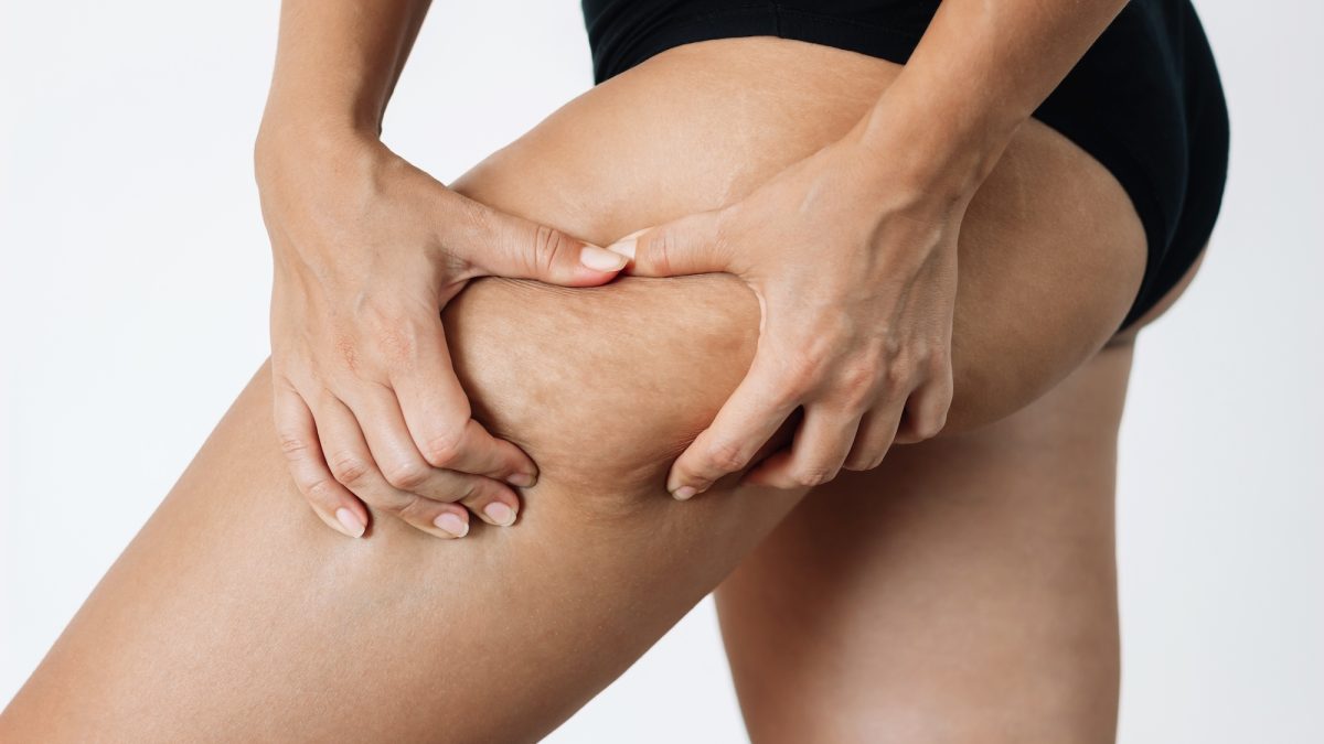5 solutions against cellulite (those that work and those that will disappoint you), according to Dr. Jean-Michel Cohen