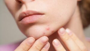 Be careful, popping a painful pimple can make the situation worse! Here's why