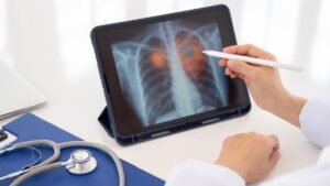 Covid-19 and lung cancer: this discovery about the Spike protein which worries American researchers
