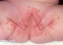 W-shaped lesions characteristic of diaper rash.