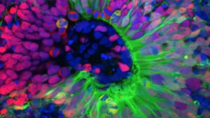 Epilepsy: the Brain Institute uses mini-brains to unravel the mystery of childhood seizures