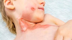 Burns: beyond healing, the cry of alarm from dermatologists about these invisible after-effects