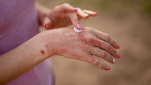 Heat and stress: how to relieve dyshidrosis, this bullous eczema that attacks your hands and feet?