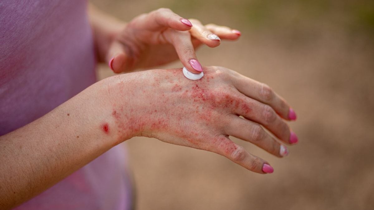 Heat and stress: how to relieve dyshidrosis, this bullous eczema that attacks your hands and feet?