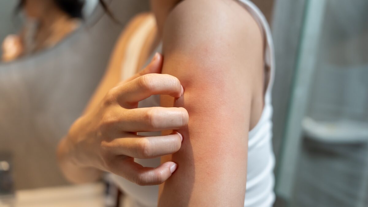 Insect bites: why you absolutely must avoid scratching and how to relieve yourself, according to our experts