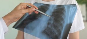 Lung cancer: a new oral treatment does better than chemotherapy in a form that is difficult to treat