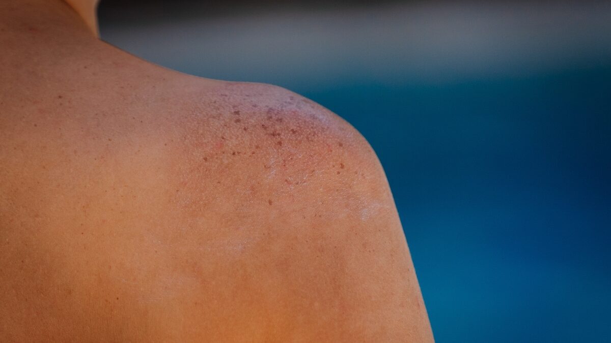 Skin cancer: these 4 misconceptions about the sun can put your health at risk