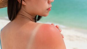 Sunburn: “here is the product to always have on hand to soothe them”, says Dr Gérald Kierzek