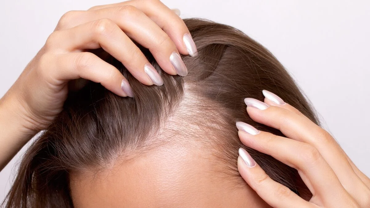 Hair loss: here are the signs that may suggest androgenetic alopecia