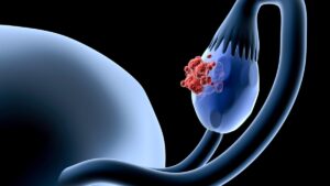 Ovarian cancer: this revolutionary implant treats and monitors the progression of the disease in real time